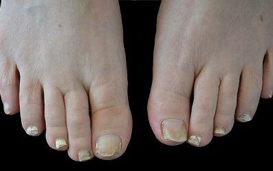 Πώς να απαλλαγείτε από το μανιτάρι στα δάχτυλά τους