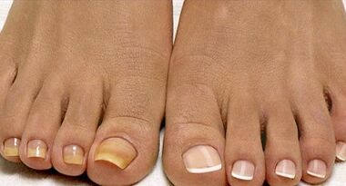 Μεθόδους θεραπείας μανιταριών στόλου