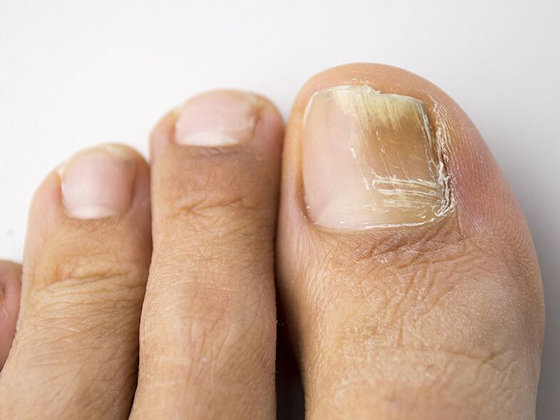 Η αρχική φάση του μανιταριού